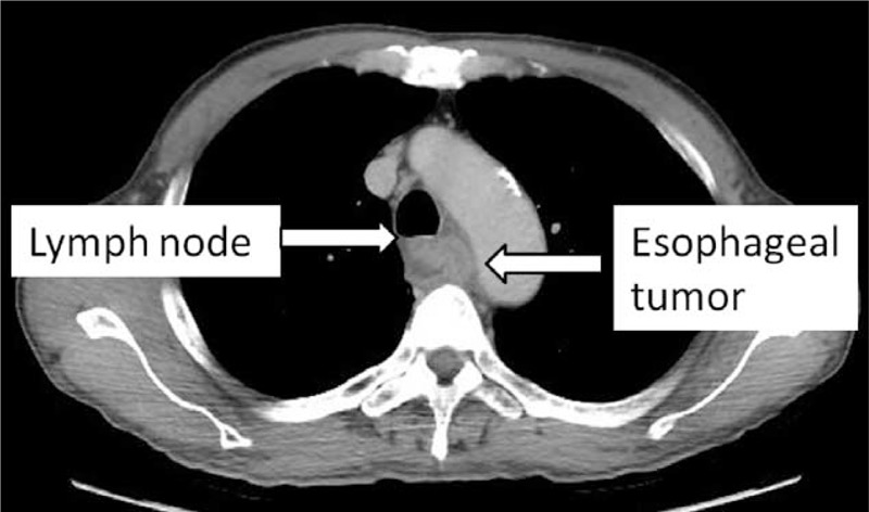 Tomografia computadorizada axial de tórax mostrando tumor do esôfago com espessamento de parede posterior à traqueia e linfonodo mediastinal aumentado, próximo à aorta — avaliação macro da relação do tumor com estruturas mediastinais no estadiamento.