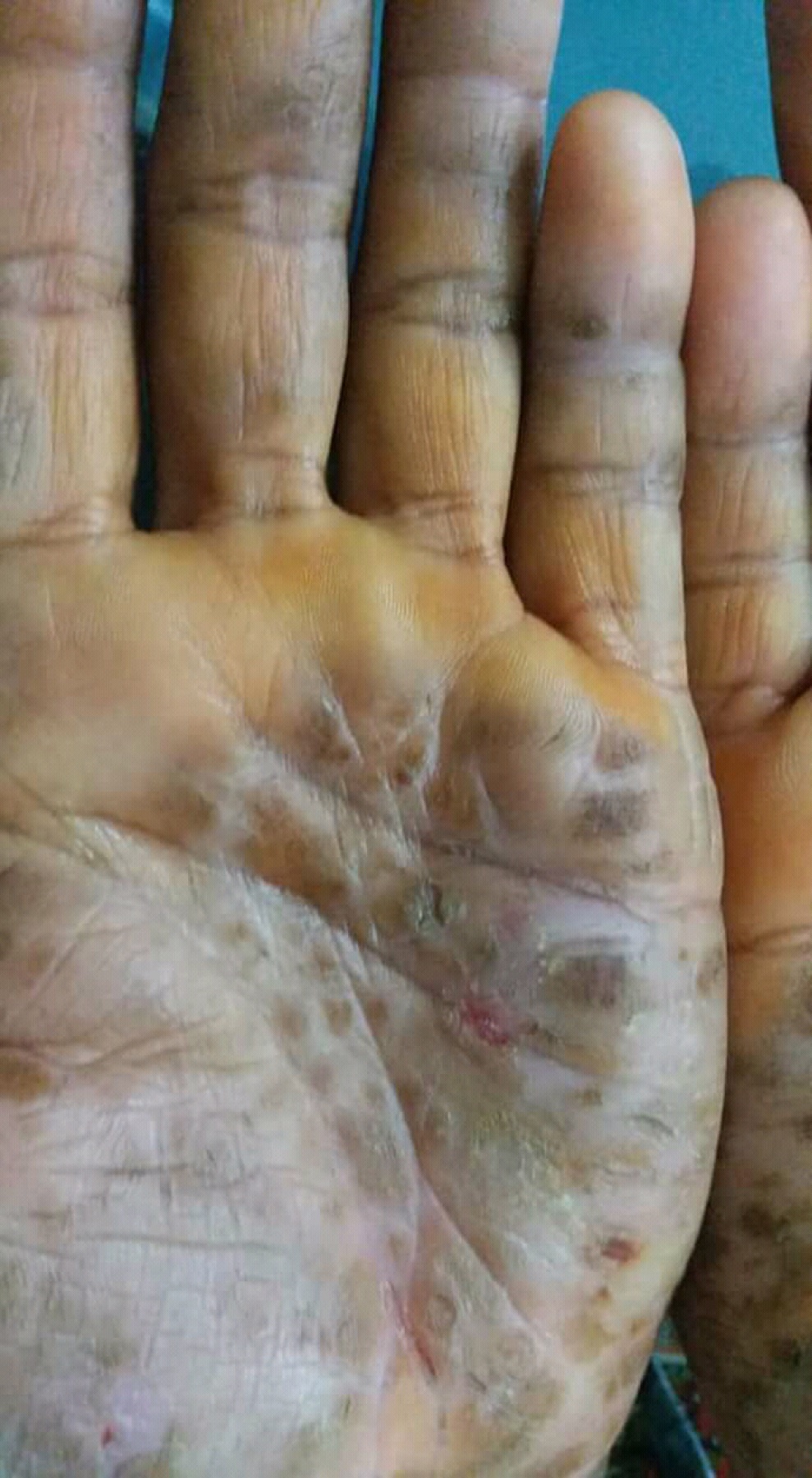 Foto clínica da palma da mão com queratodermia palmoplantar difusa: espessamento córneo e fissuras da pele palmar — achado característico da tilose, fator de risco hereditário para carcinoma escamoso de esôfago.