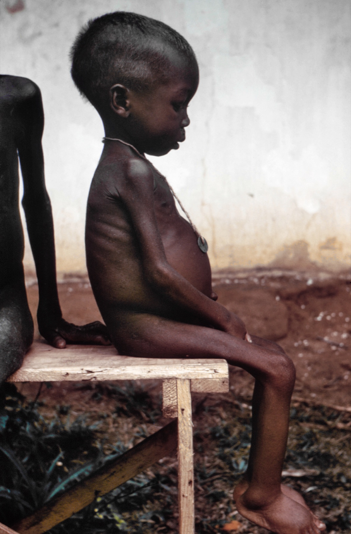 Criança com kwashiorkor apresentando edema generalizado, abdome distendido e cabelo descolorido — o conjunto de achados que define o caso de Josué.