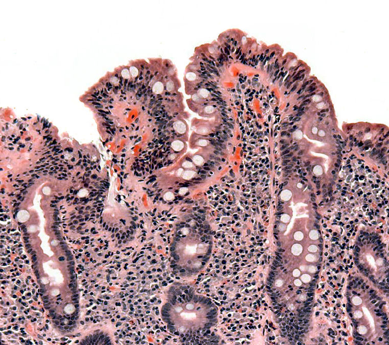 Lâmina histológica de mucosa duodenal na doença celíaca, mostrando atrofia das vilosidades intestinais — base da má absorção.