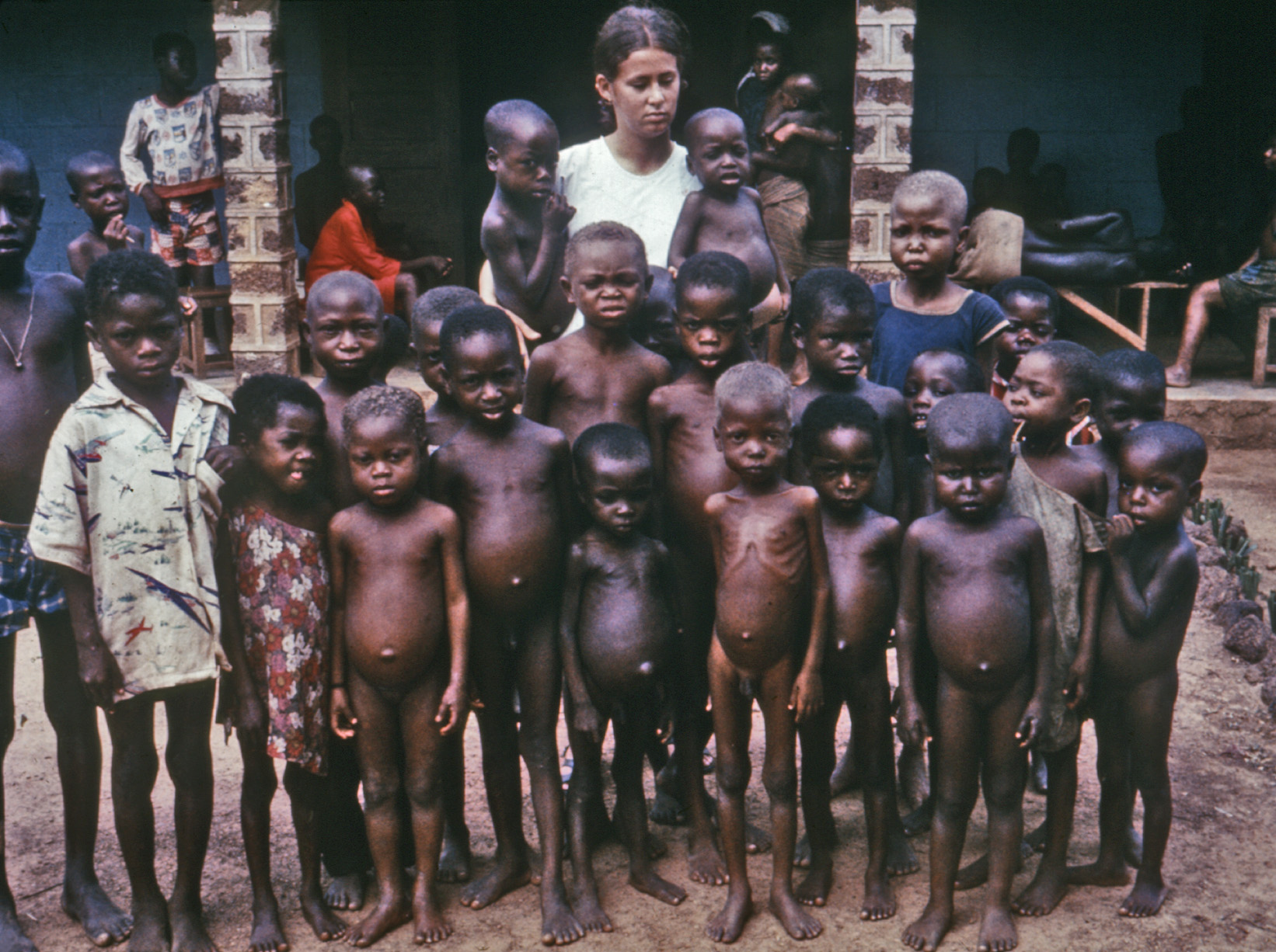 Crianças com kwashiorkor, com edema e cabelo descolorido cinza-louro típico da carência proteica.