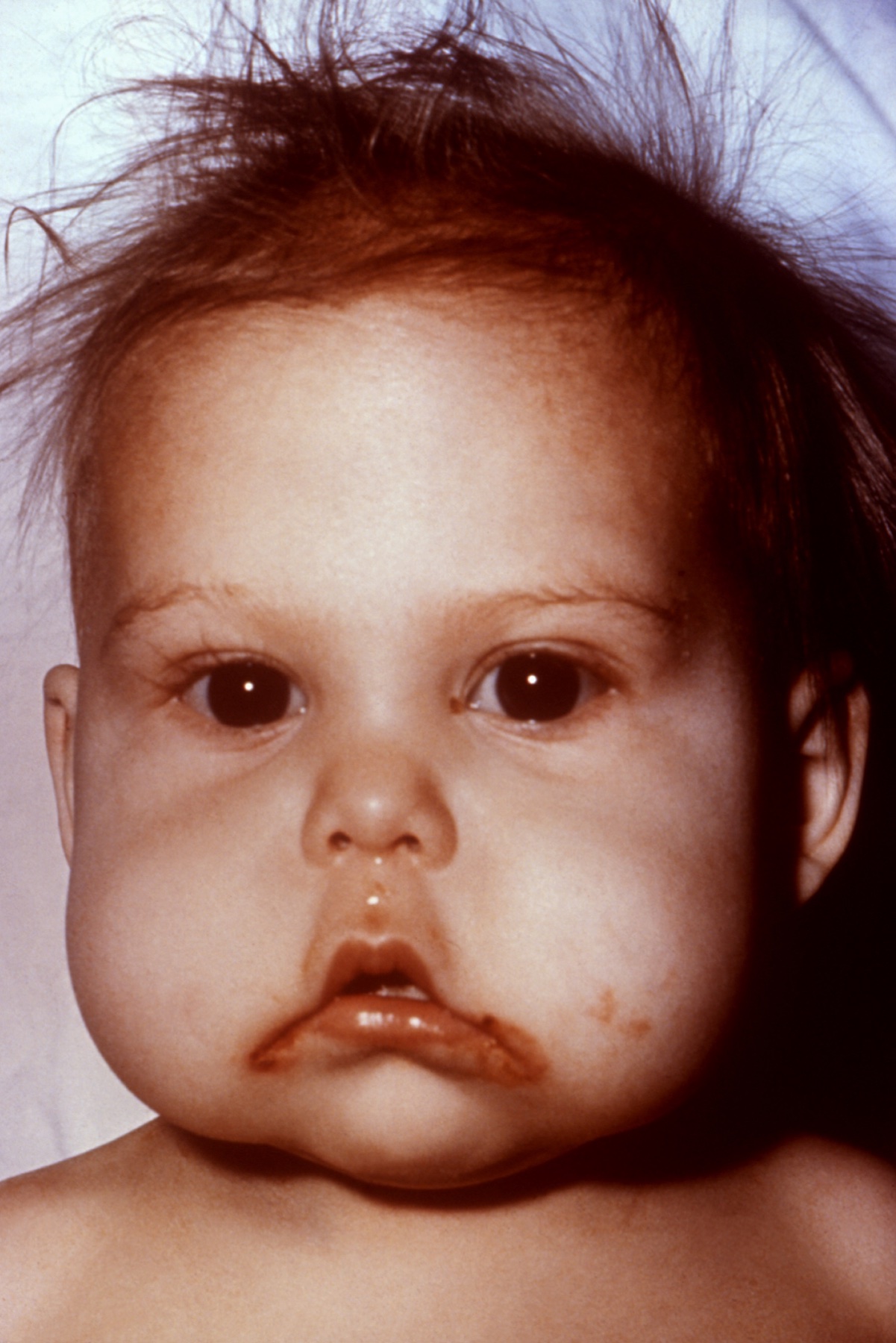Lactente com kwashiorkor mostrando o sinal da bandeira no cabelo — faixas de cor clara e escura alternadas pela carência proteica.