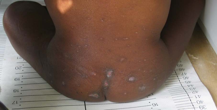 Lesão de pele (dermatose) em lactente com kwashiorkor, manifestação cutânea da carência proteica grave.