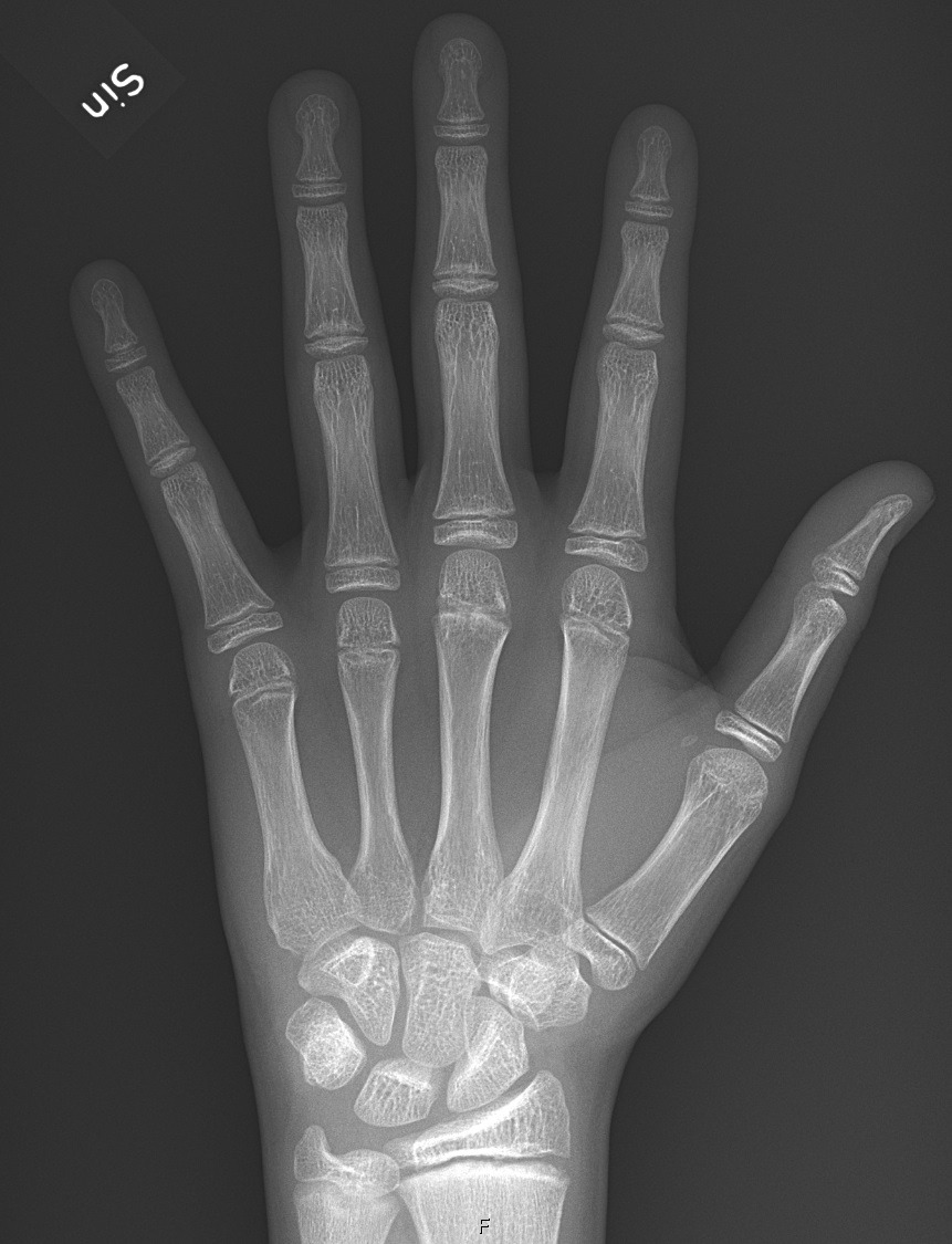 Radiografia da mão e punho esquerdos mostrando placas de crescimento abertas e núcleos de ossificação dos ossos do carpo, usada para estudo de idade óssea.