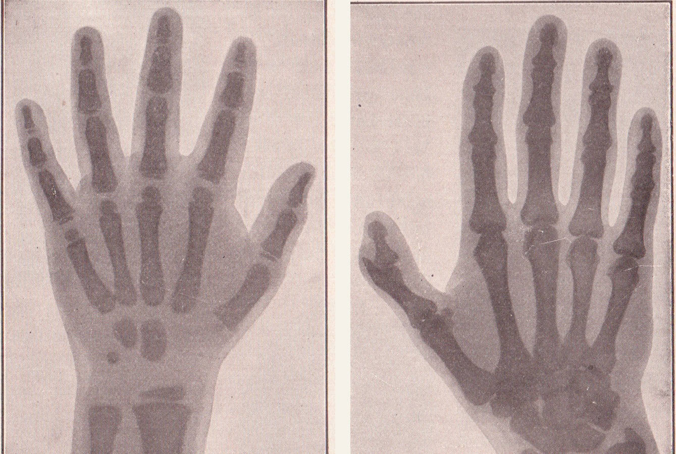 Comparação de duas radiografias de mão: à esquerda a de uma criança, com poucos ossos do carpo ossificados e fises largas; à direita a de um adulto, com ossificação completa.