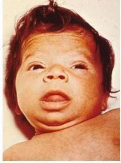 Lactente de 3 meses com hipotireoidismo congênito não tratado, mostrando fácies mixedematosa e macroglossia.