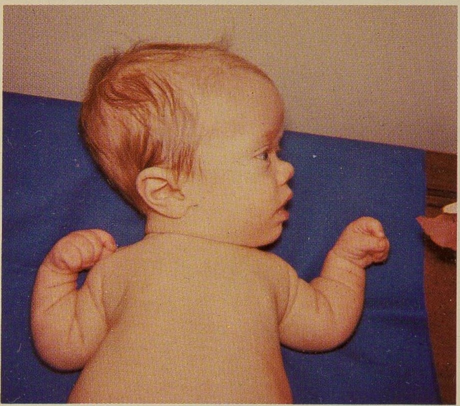 Paciente com acondroplasia em corpo inteiro, mostrando membros curtos com tronco de tamanho preservado — desproporção rizomélica.