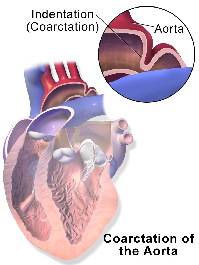 Esquema do coração mostrando coarctação da aorta — estreitamento da aorta logo após o arco, com detalhe ampliado da indentação.
