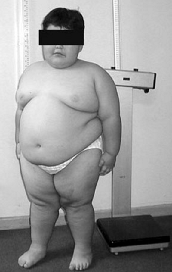 Criança de 8 anos com síndrome de Prader-Willi mostrando obesidade central (troncular) e baixa estatura; tarja preta sobre os olhos preservando a identidade.