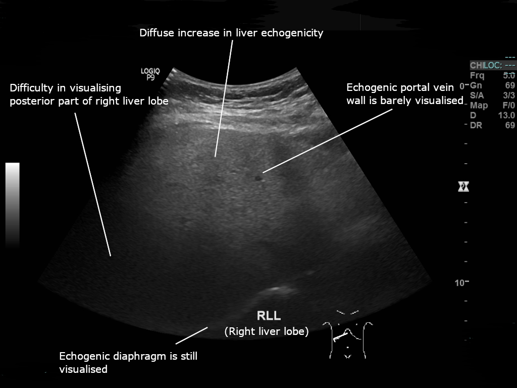 Ultrassonografia hepática mostrando esteatose grau 2: fígado difusamente hiperecogênico (brilhante) com atenuação posterior, achado de gordura no fígado.