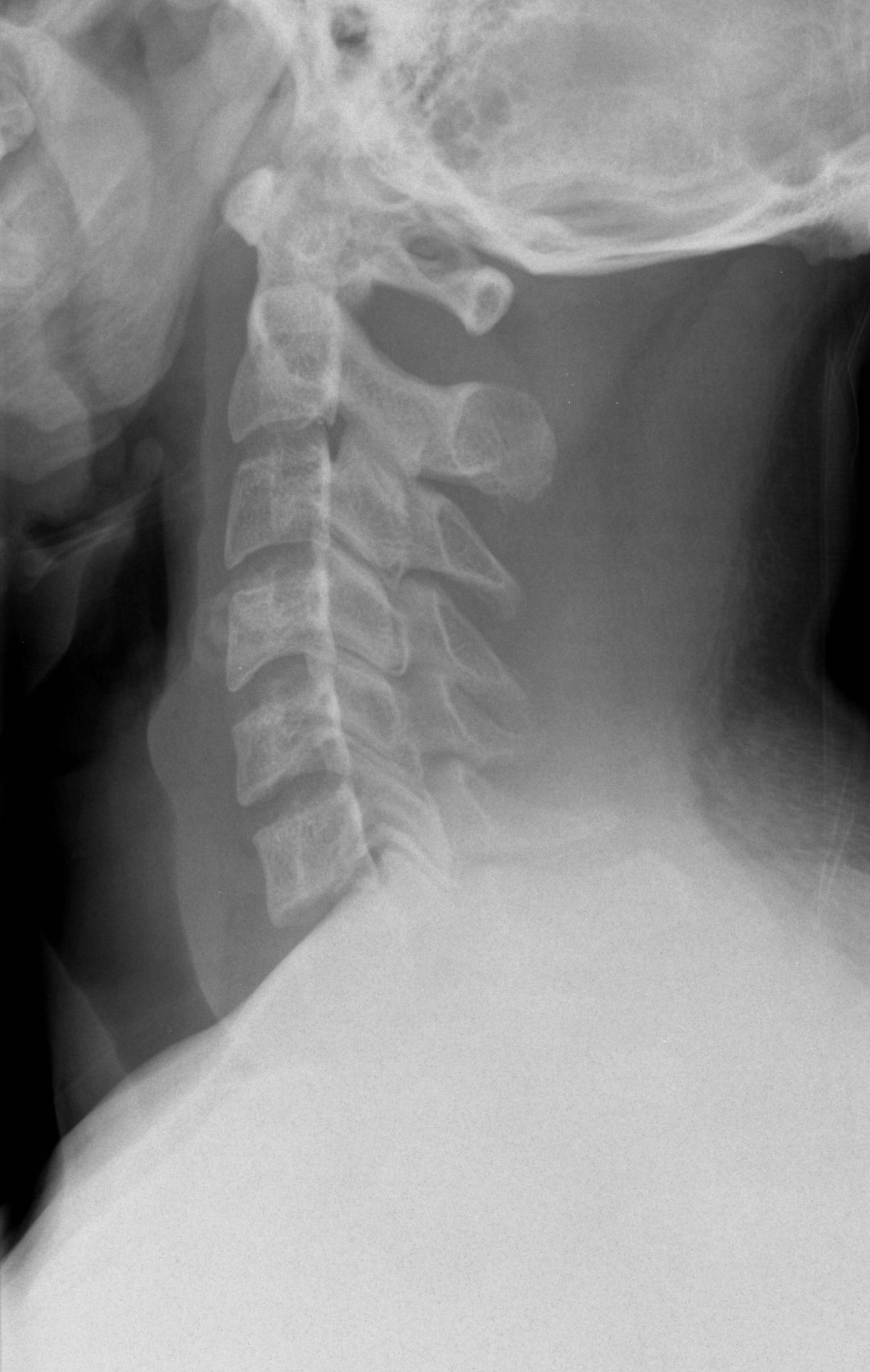 Radiografia de coluna cervical em perfil, evidenciando o arco anterior do atlas (C1), o odontoide do áxis (C2) e o intervalo atlanto-dental.