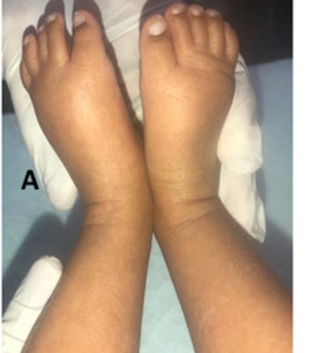 Dorso dos pés de recém-nascida com linfedema bilateral firme até os tornozelos.