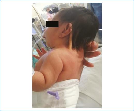 Paciente com pterígio coli (pescoço alado): dobra cutânea lateral ampla do mastóide ao ombro.