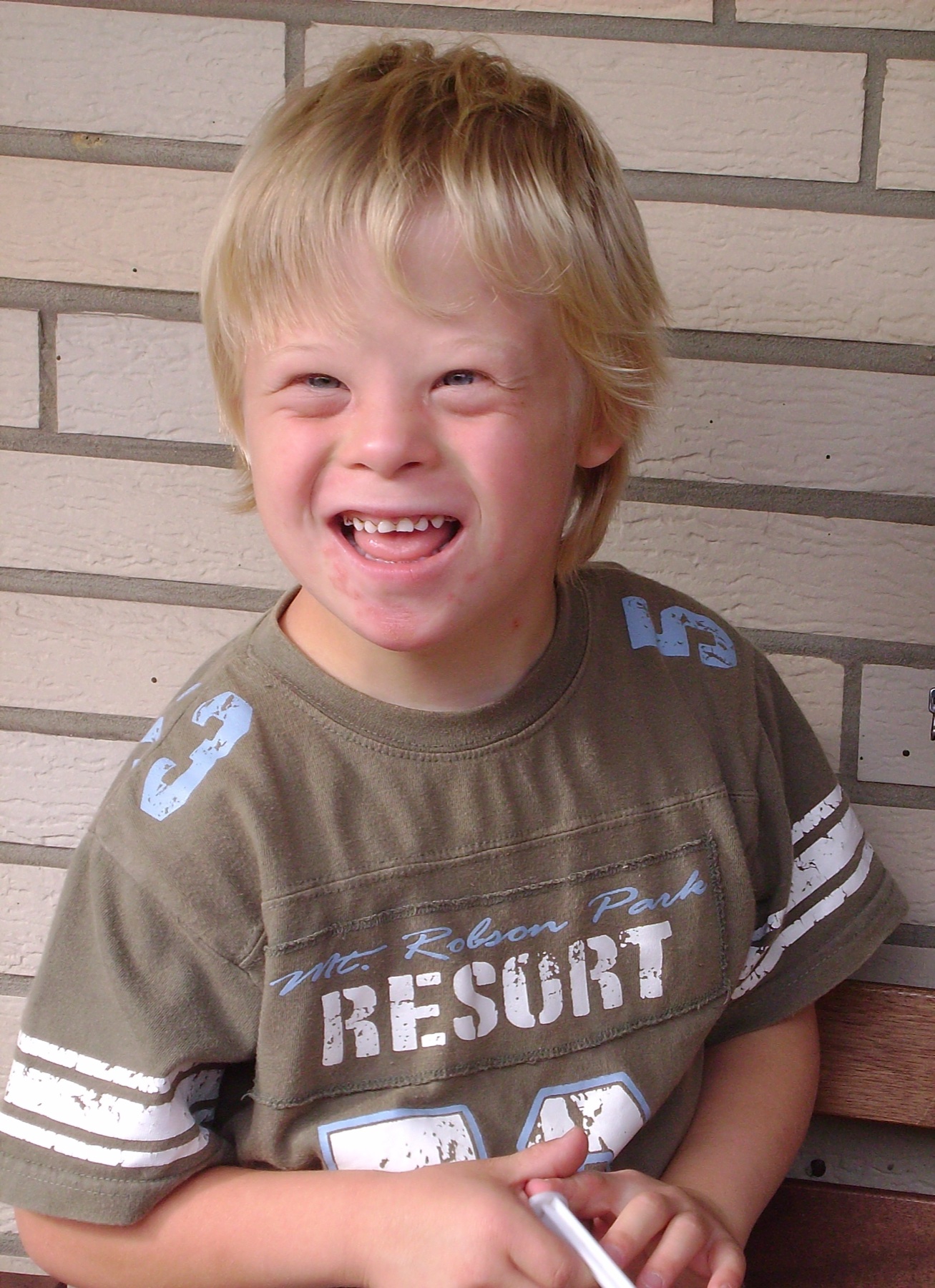 Menino de 8 anos com fenótipo de síndrome de Down, com a face globalmente reconhecível.