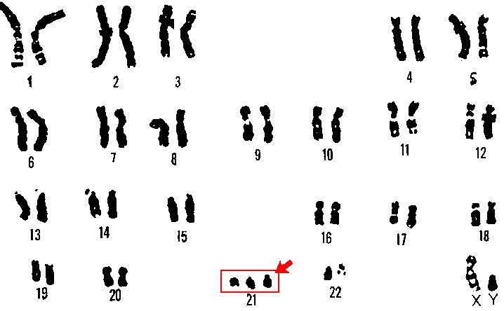 Cariótipo humano 47,XY,+21 com o par 21 exibindo três cromossomos, evidenciando a trissomia do 21.