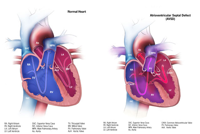Esquema anatômico de defeito do septo atrioventricular (DSAV), mostrando a valva atrioventricular comum e a comunicação septal.