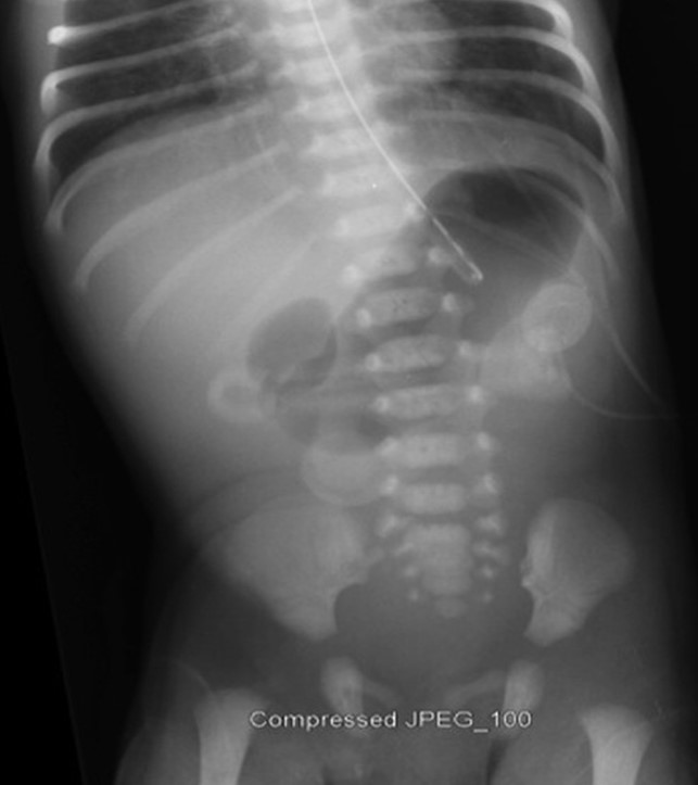 Radiografia de abdome em recém-nascido mostrando o sinal da dupla bolha: estômago e duodeno proximal dilatados, sem gás distal.