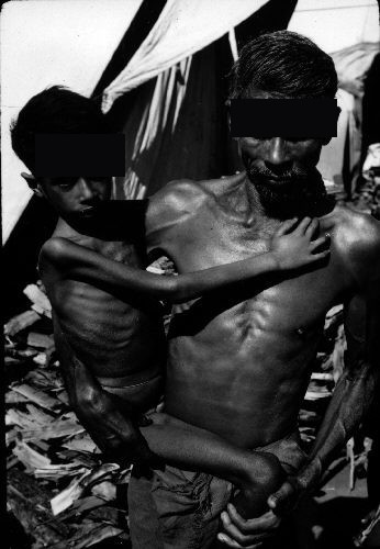 Fotografia de 1972 na Índia: criança com marasmo (desnutrição energético-proteica grave), acentuadamente abaixo do peso, com emaciação e desproporção cabeça/corpo, no colo do pai também desnutrido. Os olhos de ambos estão tarjados para preservar a identidade.