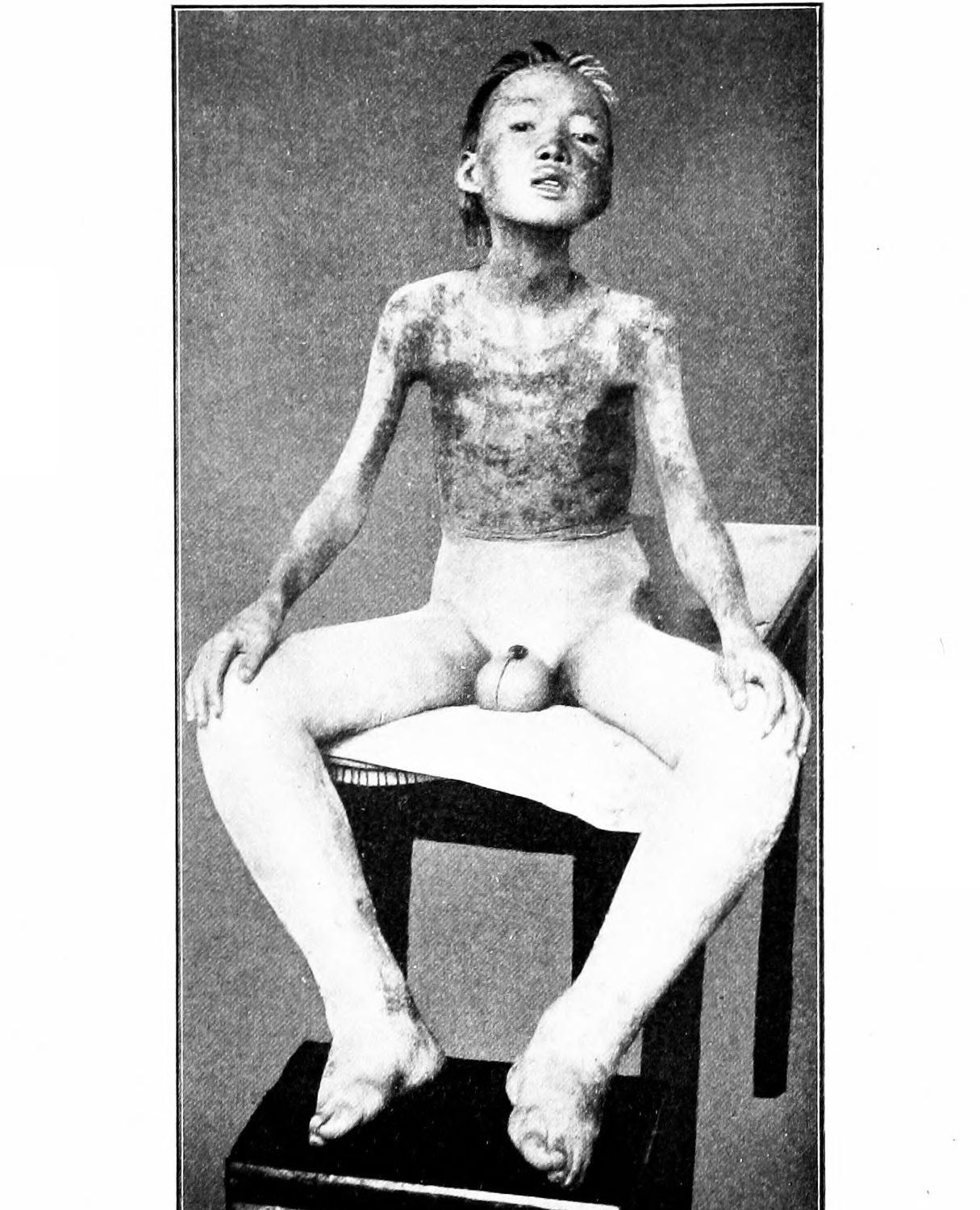 Fotografia clínica de paciente com beri-béri úmido, exibindo edema generalizado de membros inferiores abaixo da cintura e fácies de fome de ar por insuficiência cardíaca de alto débito secundária à deficiência de tiamina (vitamina B1). Olhos e região genital tarjados para preservar a identidade e a dignidade do paciente.