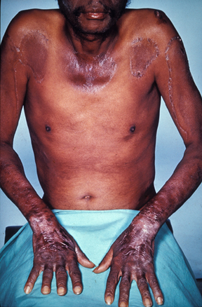 Dermatite pelagrosa fotossensível com distribuição em áreas expostas (colar de Casal).