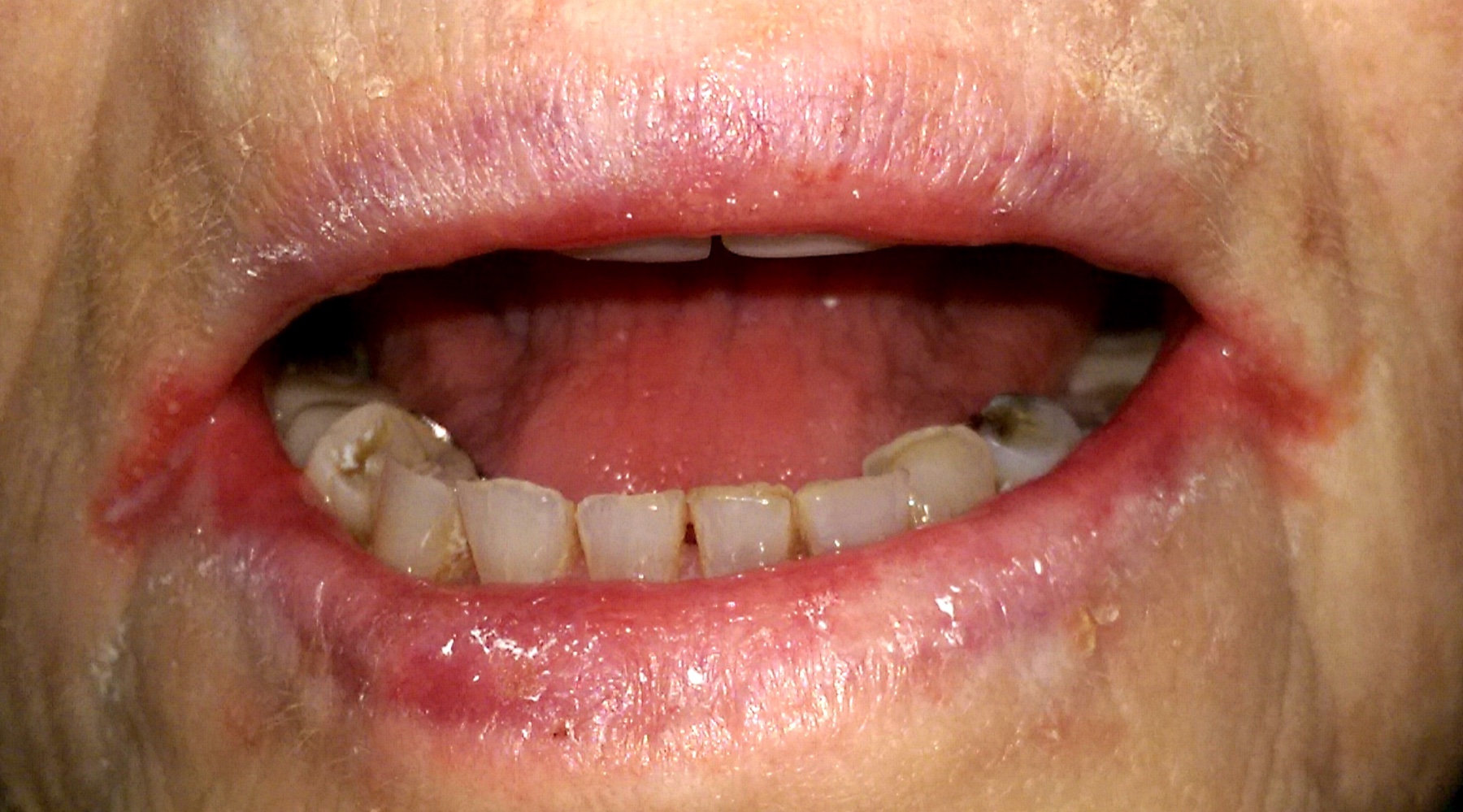Fotografia clínica de queilite angular bilateral — fissuras e eritema avermelhado nas duas comissuras labiais, achado mucocutâneo inespecífico associado a várias carências vitamínicas e à deficiência de ferro.
