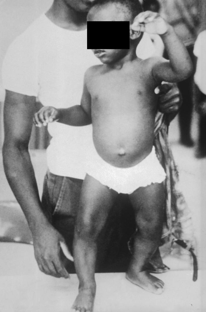 Criança com raquitismo carencial e arqueamento varo (geno varo) dos membros inferiores.