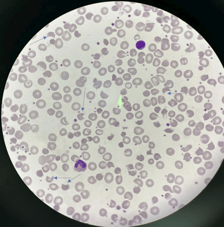 Esfregaço de sangue periférico em microscopia óptica mostrando picnócitos — eritrócitos pequenos, densos e irregularmente contraídos indicados por setas azuis — ao lado de burr cells e hemácias fragmentadas, na picnocitose infantil associada à deficiência de vitamina E.
