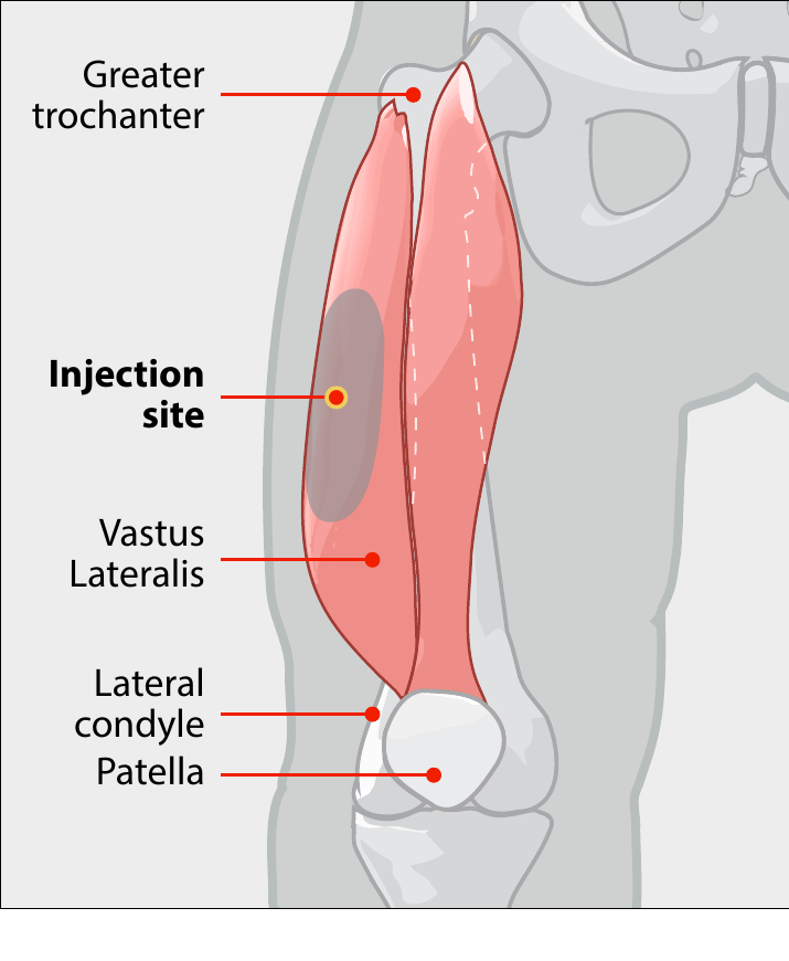 Diagrama do músculo vasto lateral na coxa, indicando o sítio antero-lateral de injeção intramuscular, com os reparos ósseos (trocânter maior, côndilo lateral, patela) — rota usada na profilaxia de vitamina K do recém-nascido.