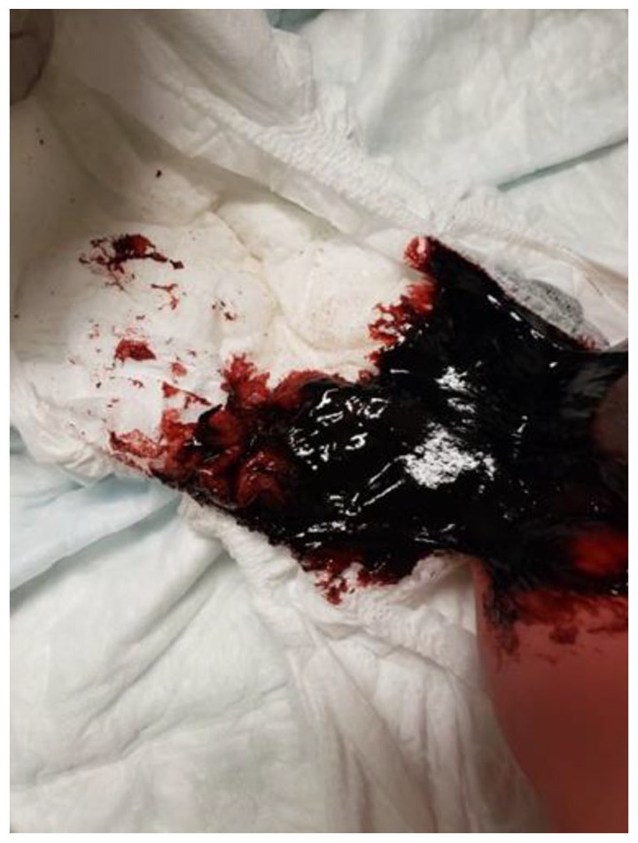Fralda de recém-nascido com mecônio volumoso e sangue vivo abundante — achado de melena neonatorum que motiva o teste de Apt-Downey para diferenciar sangue fetal de sangue materno deglutido.