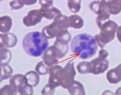 Esfregaço de sangue periférico de paciente com anemia megaloblástica; seta vermelha aponta neutrófilo com núcleo hipersegmentado de cinco ou mais lóbulos.