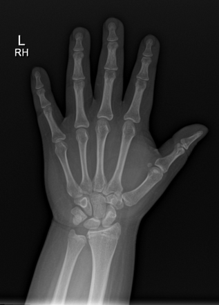 Radiografia de mão e punho com idade óssea muito acima da idade cronológica, em contexto de puberdade precoce.
