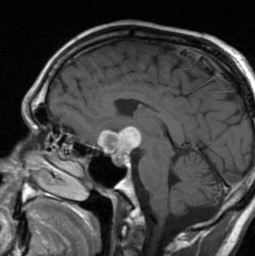Ressonância magnética sagital T1 pós-contraste mostrando massa sólida-cística selar/suprasselar compatível com craniofaringioma.