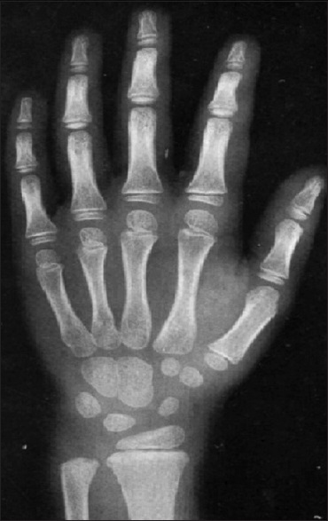 Radiografia AP da mão e punho com maturação óssea incompatível com a idade cronológica.